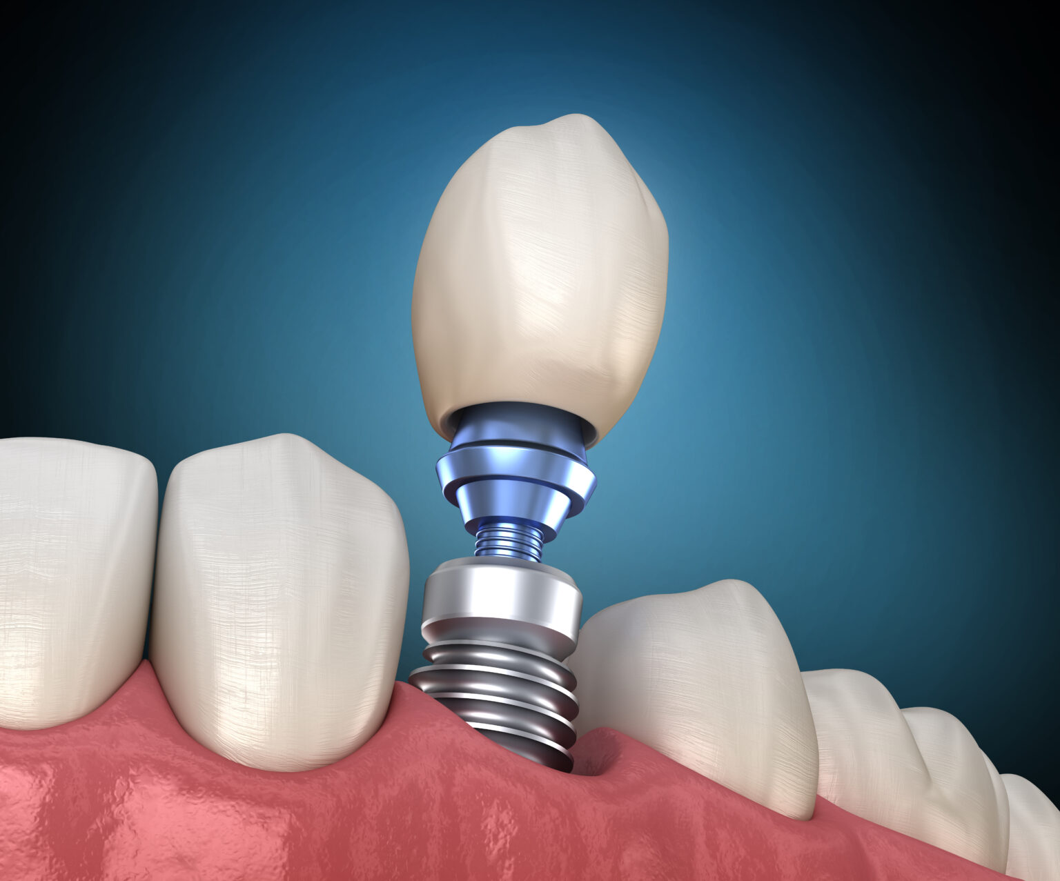 Имплантация гарантия. Astra Tech импланты. Premolar Tooth Recovery with Implant. Medically accurate 3d illustration of Human Teeth and Dentures Concept. Имплантация в эстетически значимой зоне.